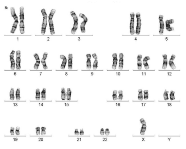 Visual representation of chromosomes - missing one copy of X