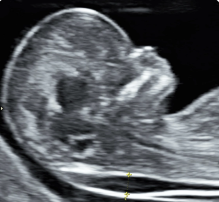 Ultrasound showing a baby with increased fluid at the back of the neck
