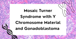 Mosaic Turner Syndrome with Y Chromosome Material and Gonadoblastoma