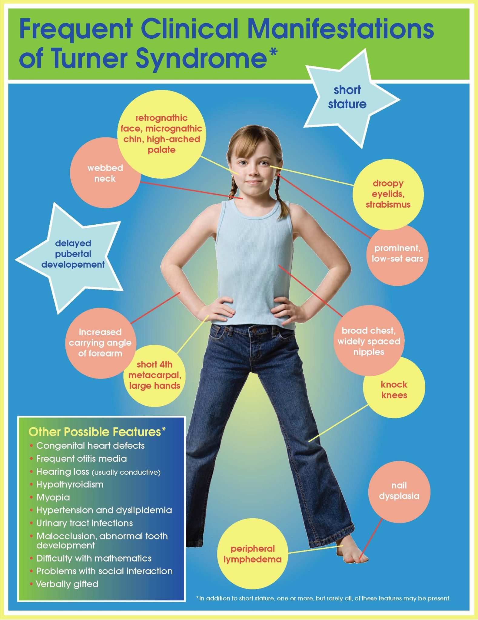 Clinical Phenotype Of Turner Syndrome Turner Syndrome Foundation